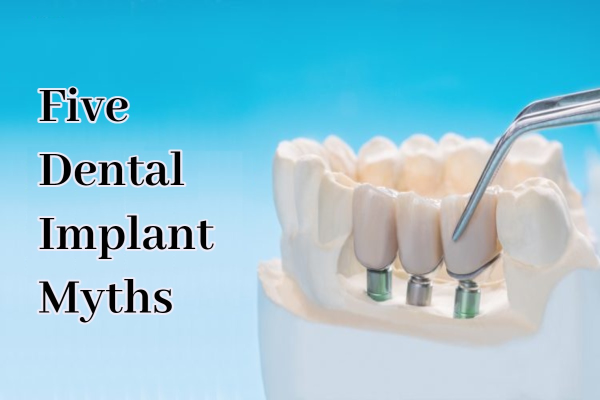teeth implants near me