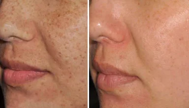 IPL Skin Rejuvenation