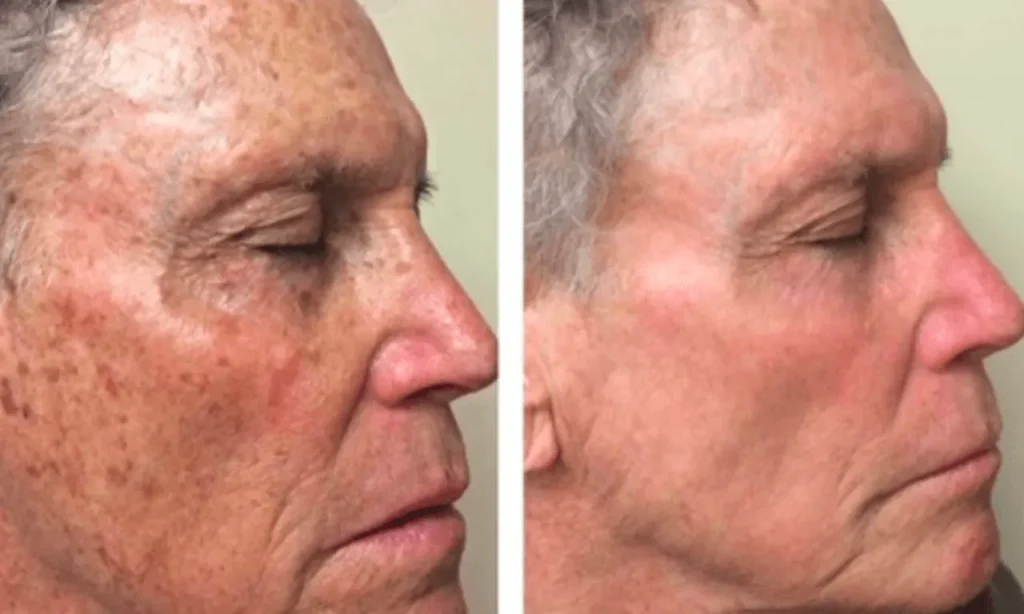Hyperpigmentation