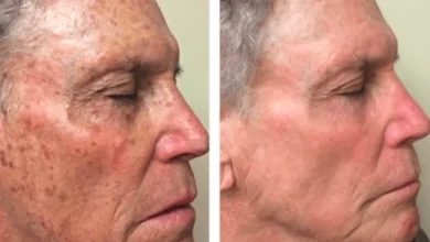 Hyperpigmentation
