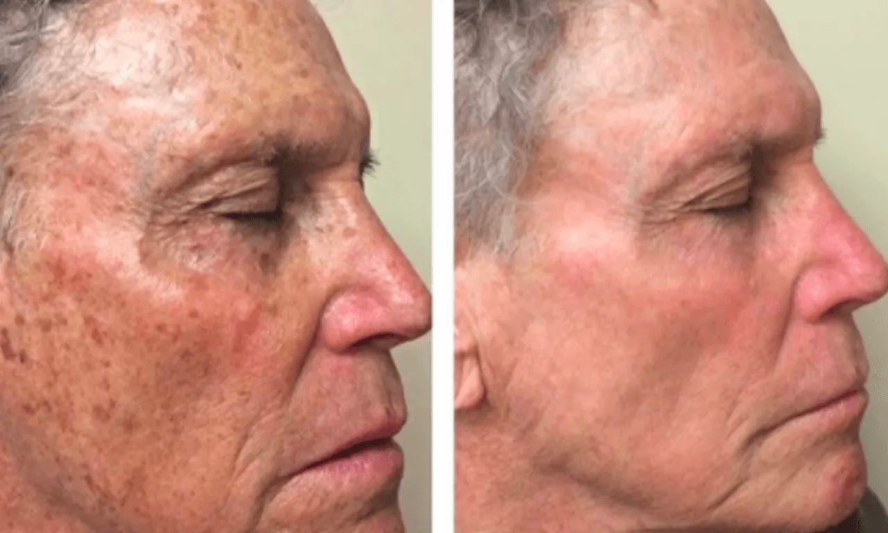 Hyperpigmentation
