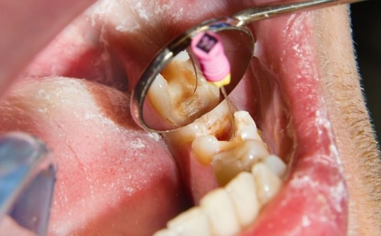 Root Canal